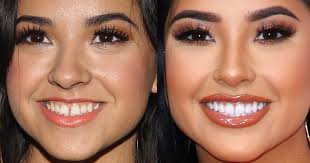 becky g s teeth gap before and after