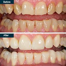 Insurance companies make money because the funds available that are never used are kept by the insurance companies. Dental Bonding In The Bronx Ny Cosmetic Teeth Bonding