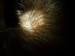 scalp fungal infection