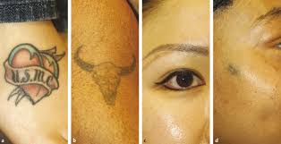 removal of tattoos and permanent makeup