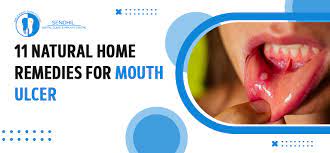 11 home remes for mouth ulcer dr