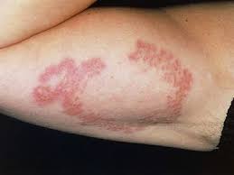 These pictures of granuloma annulare show what you may see on your skin. Disseminated Granuloma Annulare Armpit Rash Granuloma Annulare Rash Treatment
