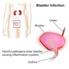 q a how to treat painful bladder syndrome