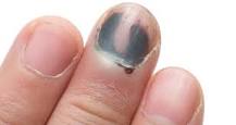 What does a black thumb nail mean?