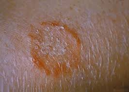 skin fungal infections types causes