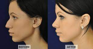 But, what if there's a simpler way that can make the life of someone with a deviated septum a little less uncomfortable. Can A Rhinoplasty Fix My Deviated Septum Nyc Specialty Aesthetic Surgery