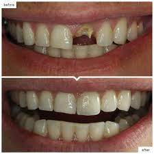 chipped tooth repair same day houston