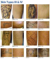 According to the american society for aesthetic plastic surgery, the national average cost of laser removal is $463 Tattoo Removal Before After Photos From Astanza