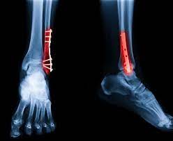 ankle fracture surgery and recovery
