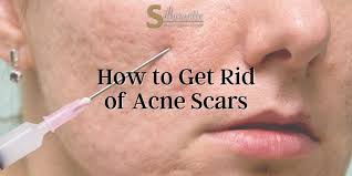 how to get rid of acne scars how to