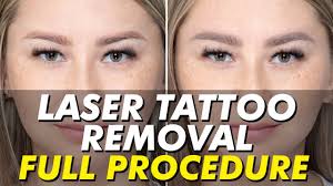 laser tattoo removal for flawless brows