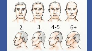 Norwood 2 Hairline 3 Ways To Stop It Naturally Before It