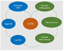 with COPD and HF The Coexistence of Chronic Obstructive Pulmonary Disease and Heart Failure: A Comprehensive Literature Review
