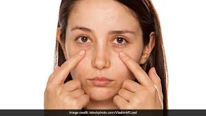 A cataract is a condition occurring in the lens of the eye offer cannot be combined with any other discounts or special offers, previous surgery, insurance, or vision care plan savings. 5 Natural Home Remedies To Remove Dark Circles Ndtv Food
