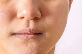 eczema on lips types symptoms