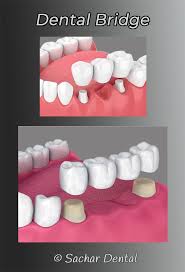 dentist nyc porcelain dental bridge