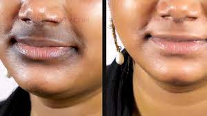 black patches around mouth in tamil