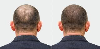 how quickly does a hair transplant