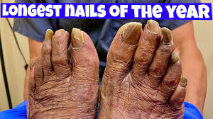 longest toenails debridement of the