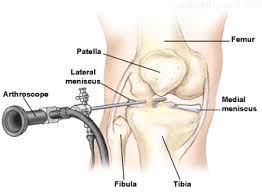 meniscus injuries