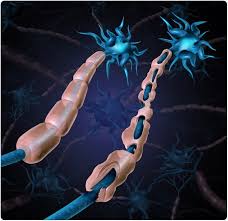 It is a neurological disorder in which the body's . Identifying Biomarkers For Guillain Barre Syndrome