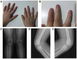 nail abnormalities and orthopedic