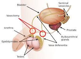 post vasectomy syndrome