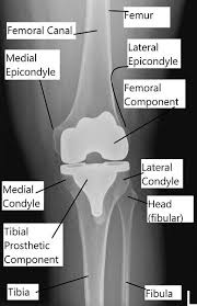 total knee replacement knee specialist