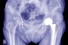 best partial hip replacement surgery