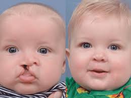 cleft lip deformity cost of surgery