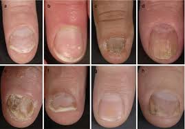 latest research in nail psoriasis