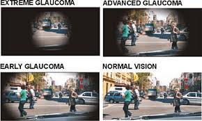 Resultado de imagen de glaucoma