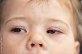 white pimple on the upper eyelid of the