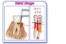 Diagnosis And Images Of Gum Disease