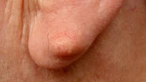 earlobe cyst symptoms causes