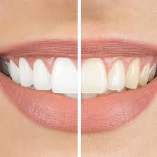 teeth cleaning vs teeth whitening