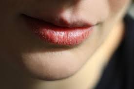 causes and treatments for dry lips