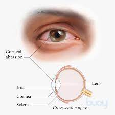 what causes scratched eye how to