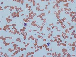 Sickle Cell Trait Wikipedia