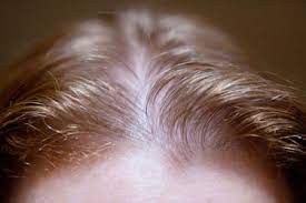 Extreme stress can cause sudden hair loss. Pictures Thinning Hair Hair Loss In Women