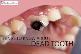 dead tooth signs symptoms causes