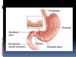 Pathology Of Peptic Ulcer