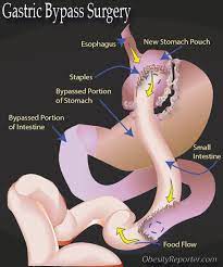 gastric byp surgery complete guide