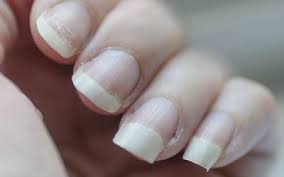 yellow nails symptoms causes and