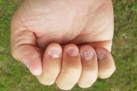 Микронихия – как лечить укороченные ногти, способы профилактики проблемы