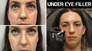 Treatment for hollow eyes, tear troughs, and slight eye bags. All About Under Eye Filler Restylane Restylane Lyft Before After Photos Does It Work Cost Youtube