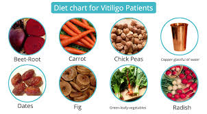 Vitiligo Diet Restrictions Chart Of Food Items For