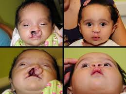 cleft lip and palate plastic surgery