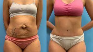 tummy tuck chicago nw indiana costs
