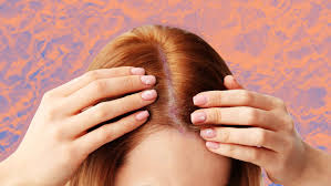 scalp psoriasis treatment options